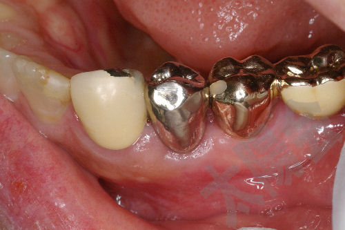虫歯の治療③
