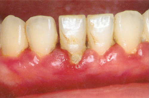 歯周病①B-1