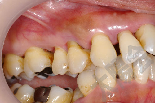歯周病/歯周外科①-1