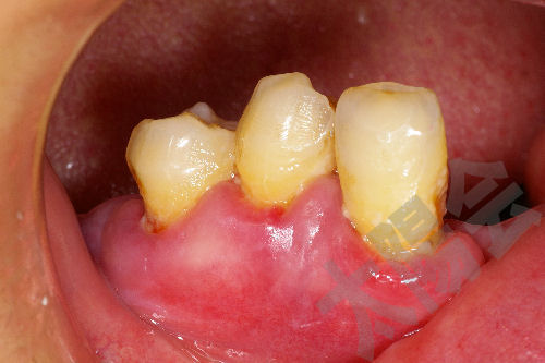 歯周外科②-1