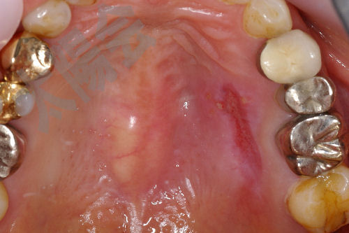 写真で見る口腔外科②-5