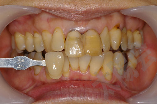 写真で見る審美歯科⑤-1