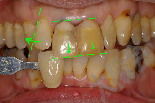 写真で見る審美歯科⑤-2